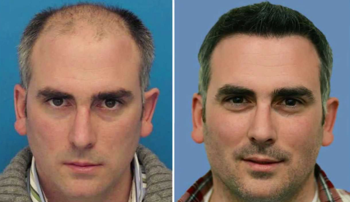 До и После пересадки волос