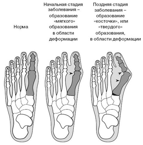 Косточка на пальце ноги: признаки, лечение и профилактика