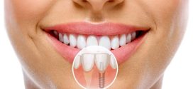 Імплантація зубів: в яку клініку краще звернутися у Житомирі