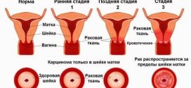 Причины появления рака шейки матки