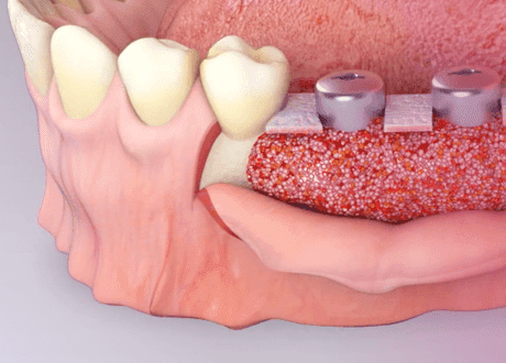 Костная Пластика Зубов: Восстановление Улыбки и Здоровья