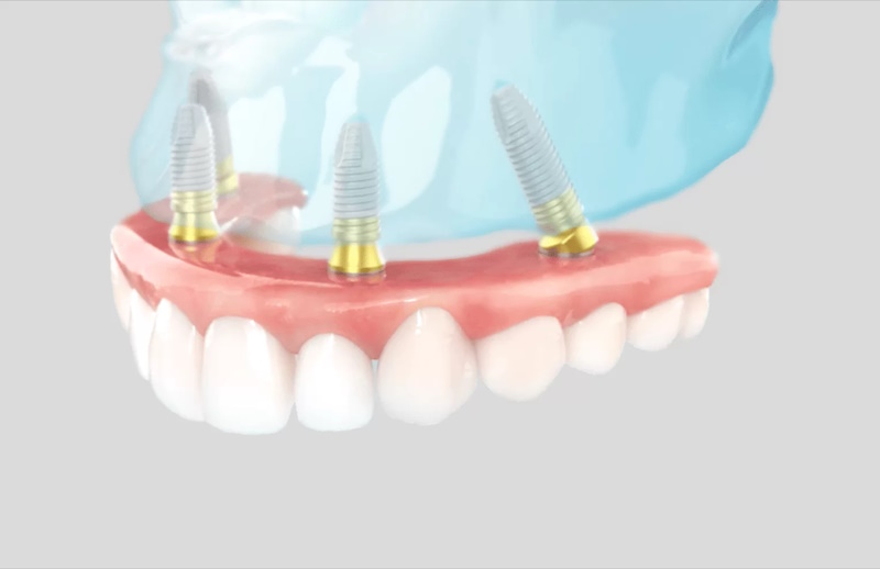 Имплантация